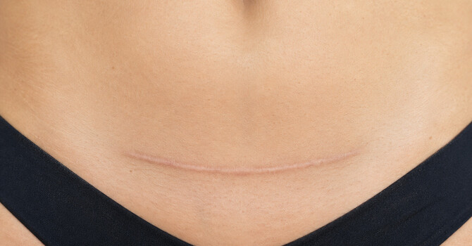 C-Section Scar Therapy